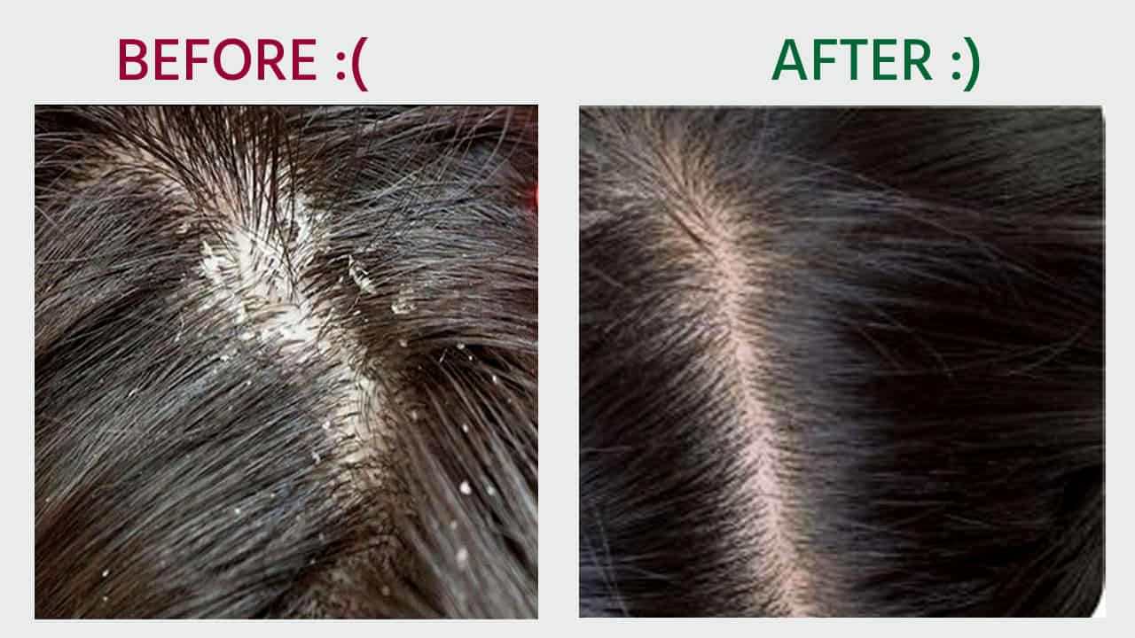 how-to-remove-dandruff-dandruff-treatment-personal-experience-best